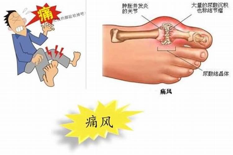 治疗痛风的最佳方法