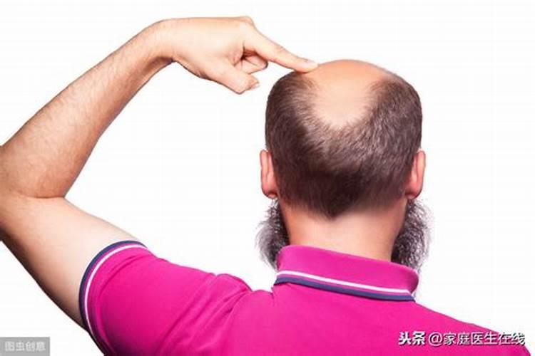 有些人两鬓风水头发秃光是什么原因