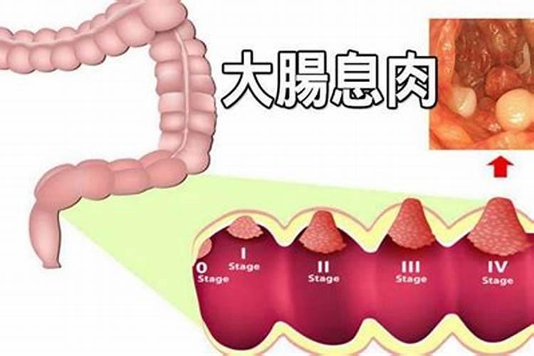 胆囊息肉风水化解