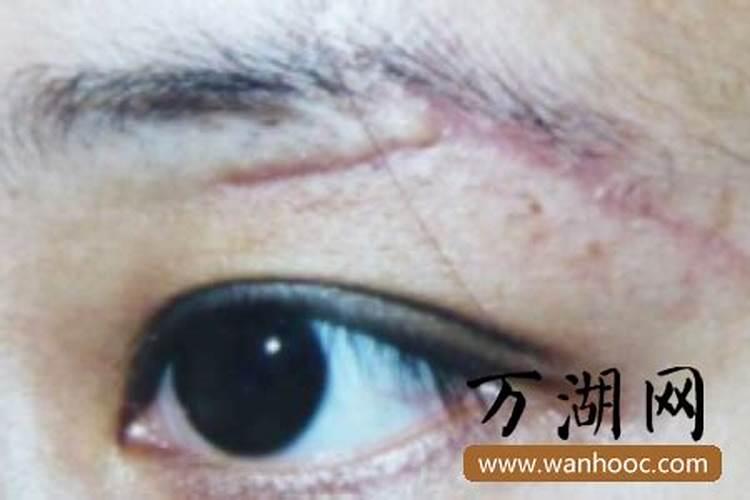 鼻子上有伤疤会影响风水吗？