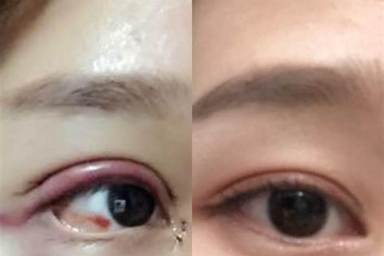 割双眼皮会破坏运势吗,做双眼皮,会不会把好运气变坏了