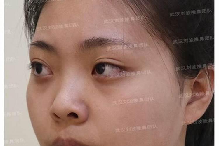 割双眼皮对人的面相会有改变吗
