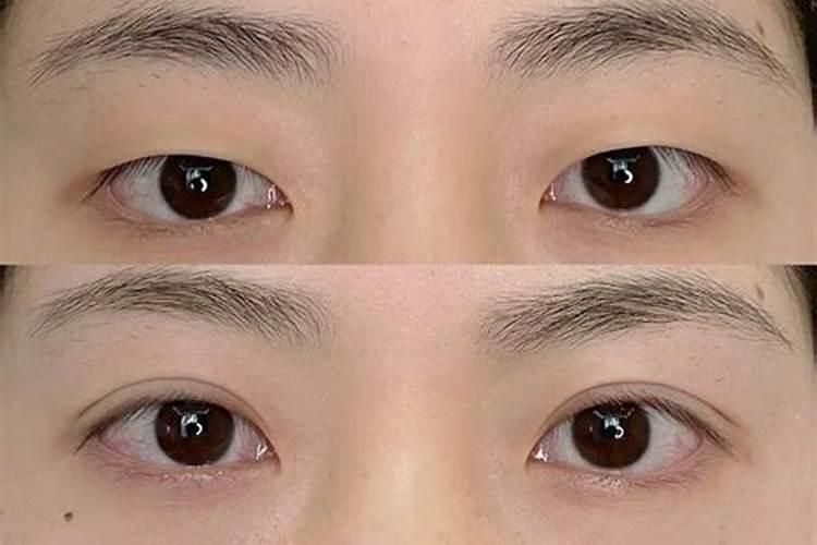 割双眼皮也要看日子吗？