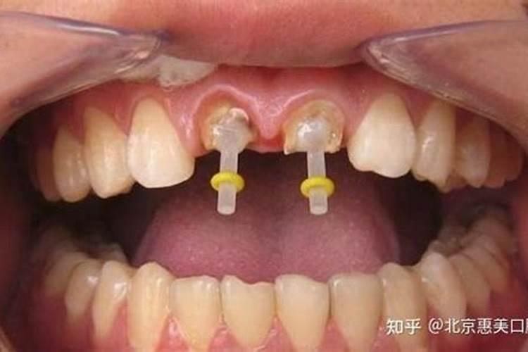 门牙有缝如何化解