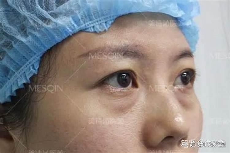 割双眼皮能改变运势吗,割双眼皮会不会影响运气