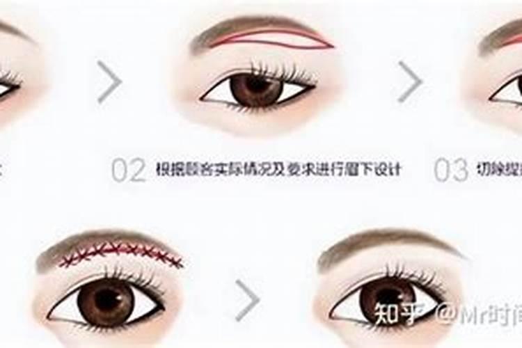 提眉后为什么眼窝凹陷,来抢先体验提眉手术后要忌口多久？