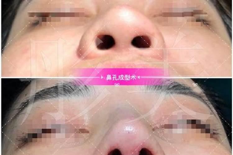 隆鼻会影响风水吗