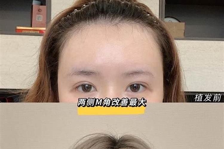 隆鼻影响运势吗,隆鼻可以改好运势吗